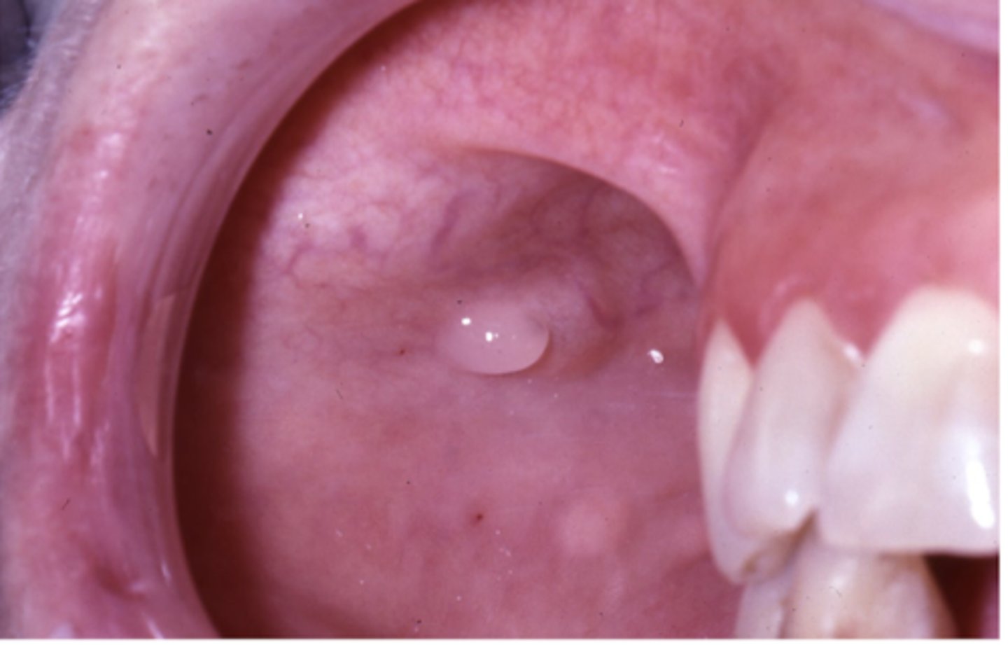 <p>the opening of stensen's duct of parotid fland is on the buccal mucosa opposite mesiobuccal cusp of maxillary first permanent molar </p>