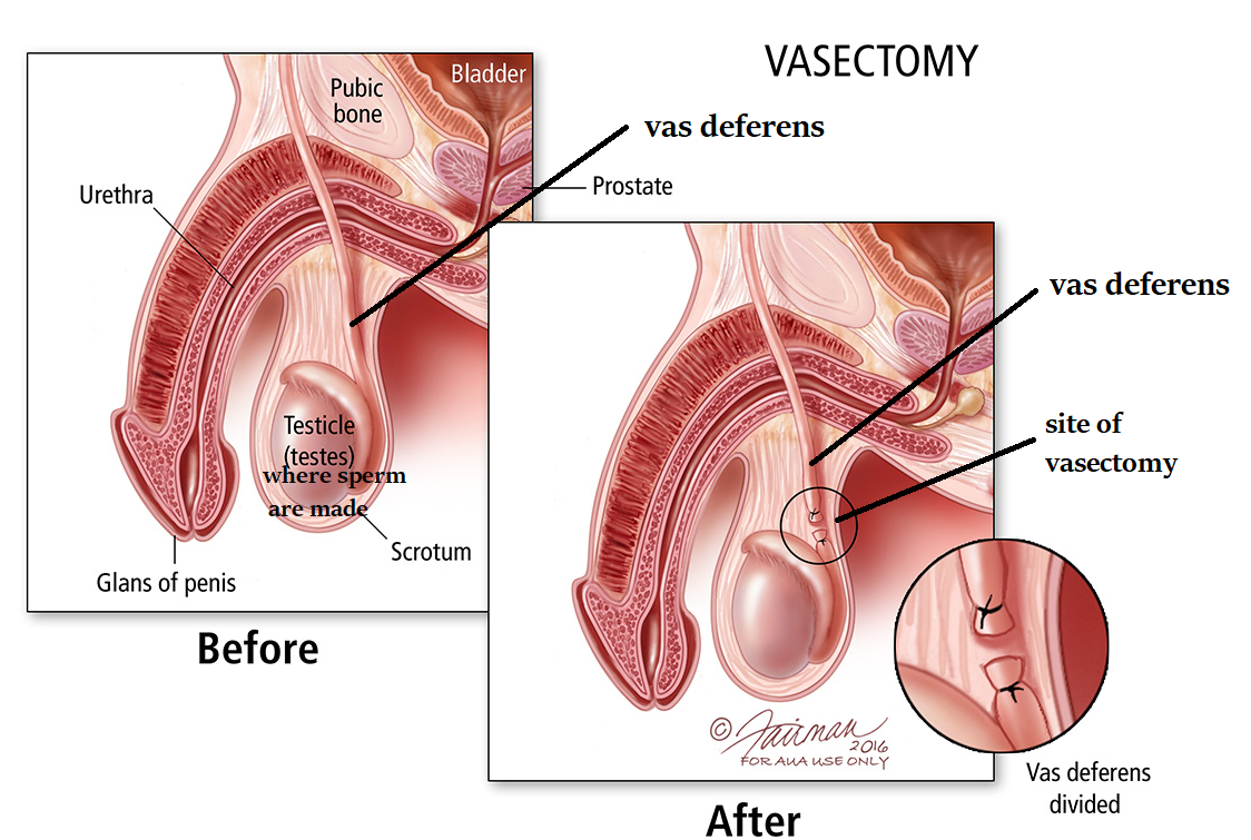 <p>Vasectomy</p>