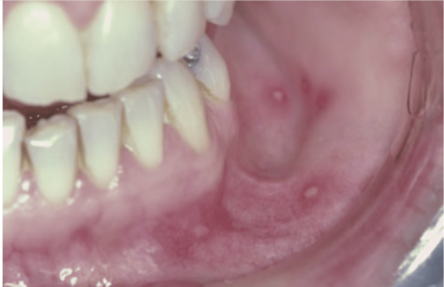 <p>Hint: Resembles herpangina but more numerous and involve anterior regions of mouth; buccal & labial mucosa & tongue are most common</p>