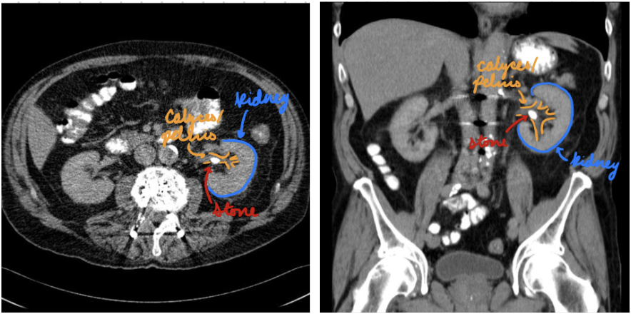 <p>Gold standard</p><p>Stones/calcifications in kidneys and ureters</p><p>Determine size, location, density, and degree of obstruction</p>