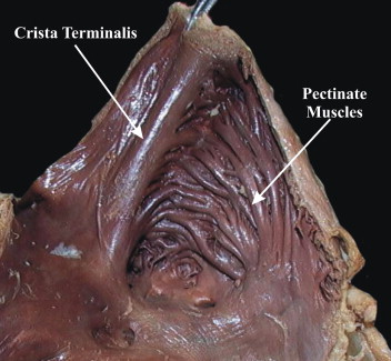 * Muscular Ridge that is the origin if Pictinate Muscles
* It is parallel to ( Sulcus Terminalis)