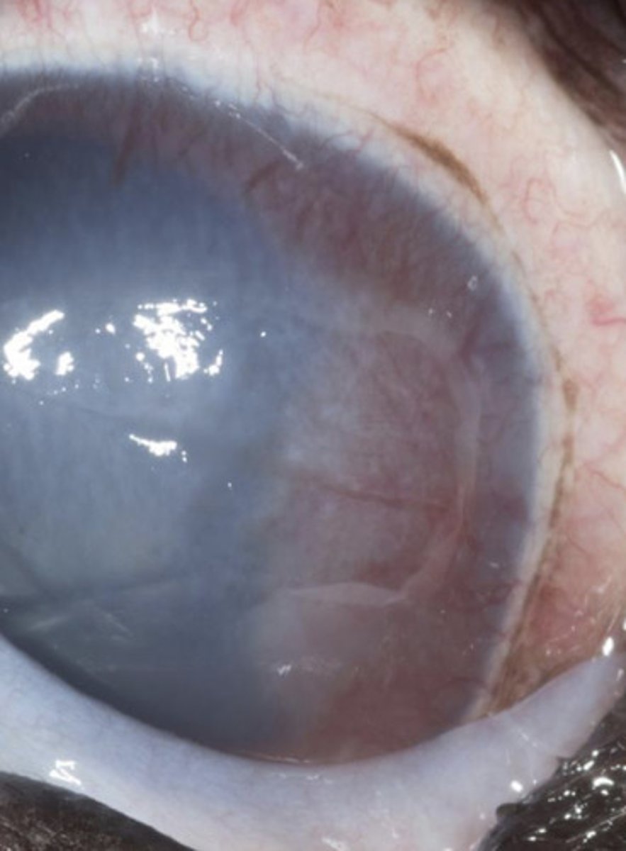 <p>What am I describing?</p><p>- Superficial ulcer</p><p>- No stromal loss</p><p>- Not infected</p><p>- Loose, non-adherent epithelium</p><p>- A stromal issue (failure to allow epithelial adherence</p>