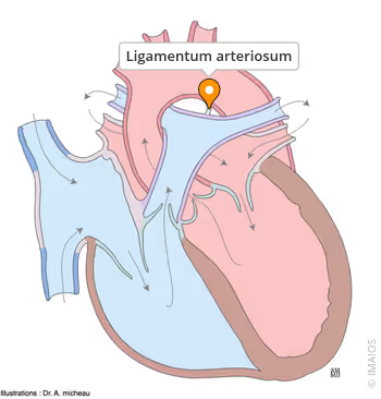 <p>What is the ligamentum arteriosum?</p><table style="min-width: 25px;"><colgroup><col style="min-width: 25px;"></colgroup><tbody><tr><td colspan="1" rowspan="1" style="margin: 0px; padding: 0.3em; position: relative;"><p>A ligament securing the aorta</p></td></tr><tr><td colspan="1" rowspan="1" style="margin: 0px; padding: 0.3em; position: relative;"><p>A remnant of the ductus arteriosus</p></td></tr><tr><td colspan="1" rowspan="1" style="margin: 0px; padding: 0.3em; position: relative;"><p>A remnant of the foramen ovale</p></td></tr><tr><td colspan="1" rowspan="1" style="margin: 0px; padding: 0.3em; position: relative;"><p>A ligament attaching the aorta to the superior vena cava</p></td></tr></tbody></table><p></p>