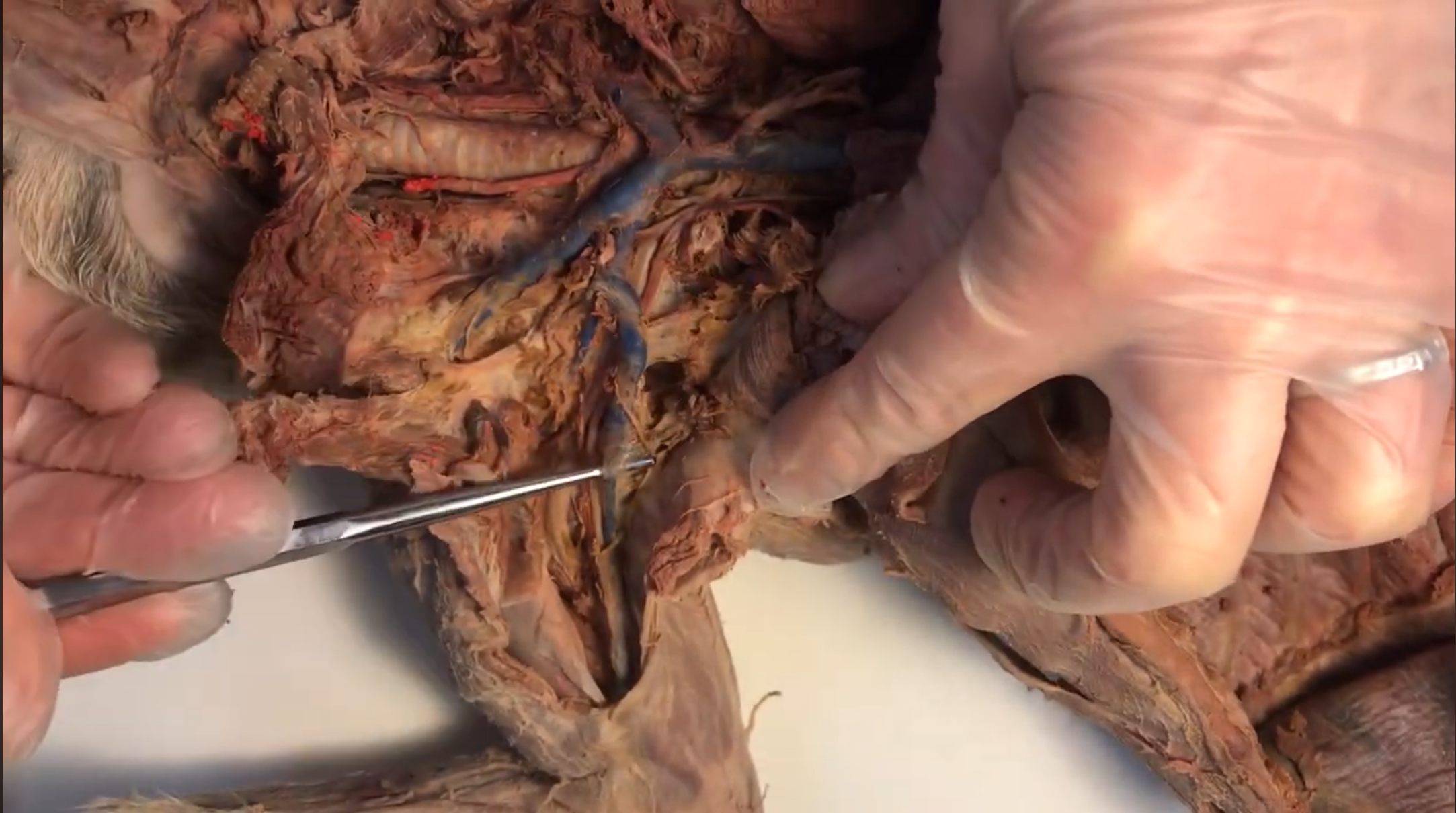 <p>What vein is this</p>