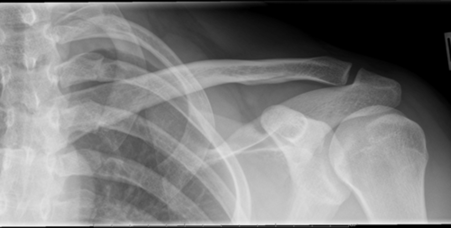 <p>1. What projection is shown in the image?</p><p>2. What are the clinical indications for this projection?</p><p>3. Is this an optimal image?</p><p>4. Name all of the anatomy.</p><p>5. Does this image meet all criteria?</p><p>6. Where is the CR placed?</p><p>7. If applicable, what method is interchangeable with this projection?</p>