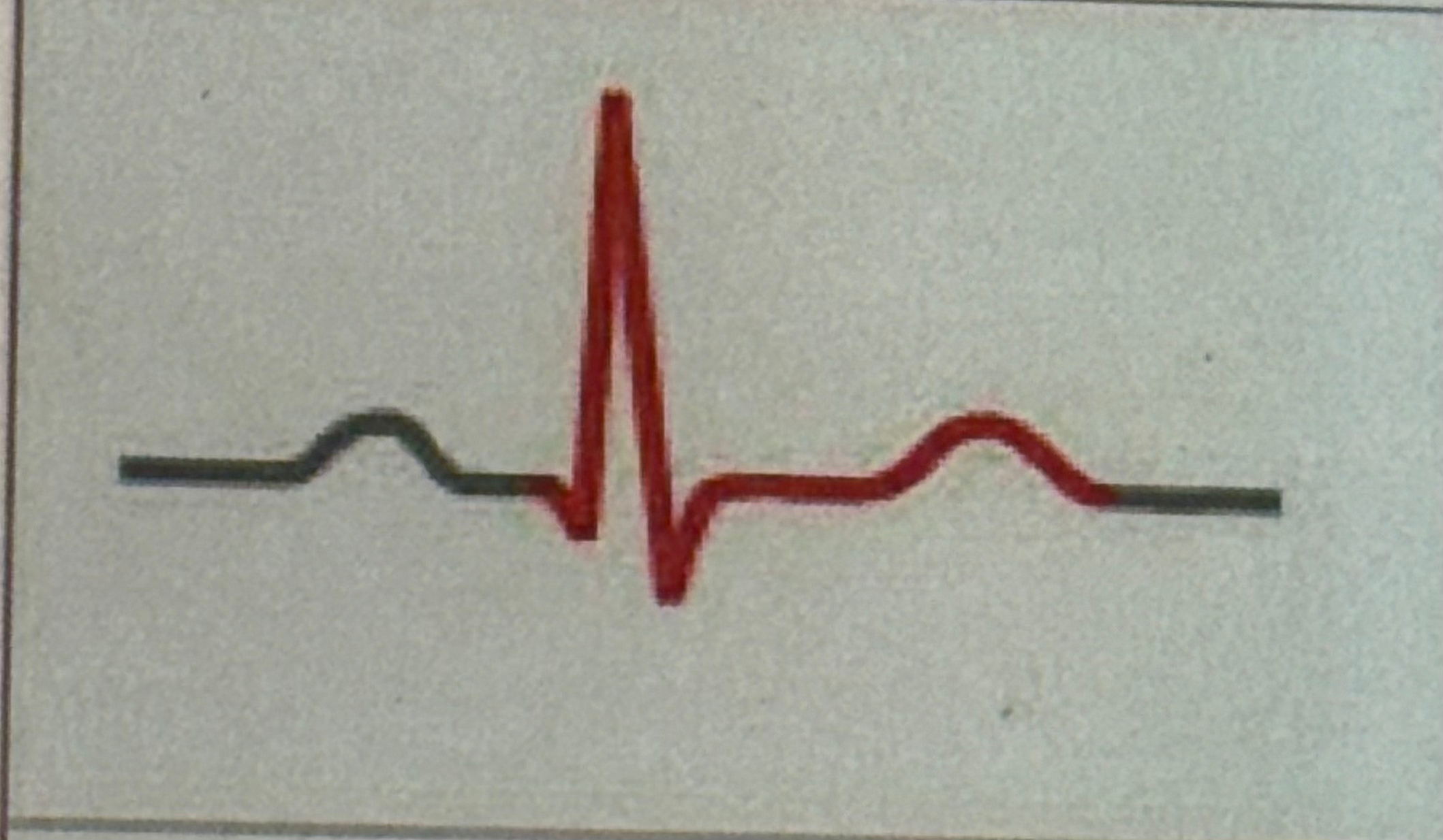 <p>time it takes for action potential to spread through ventricles </p>