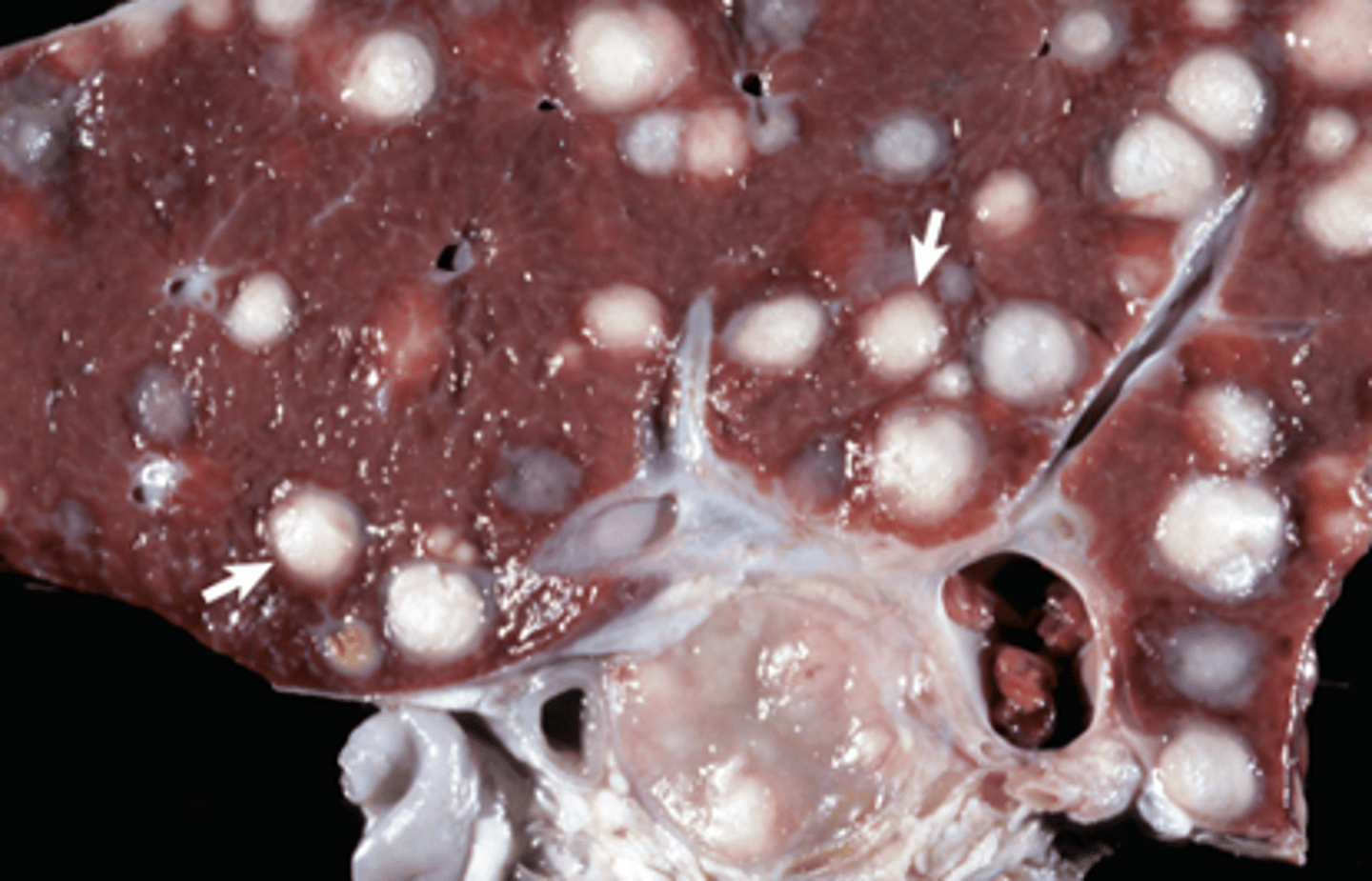 <p>What is the distribution of this lesion</p>