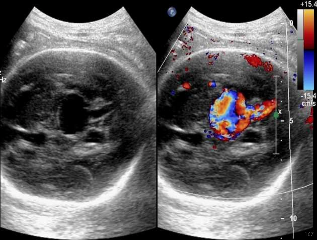 <p>What pathology is being shown?</p>