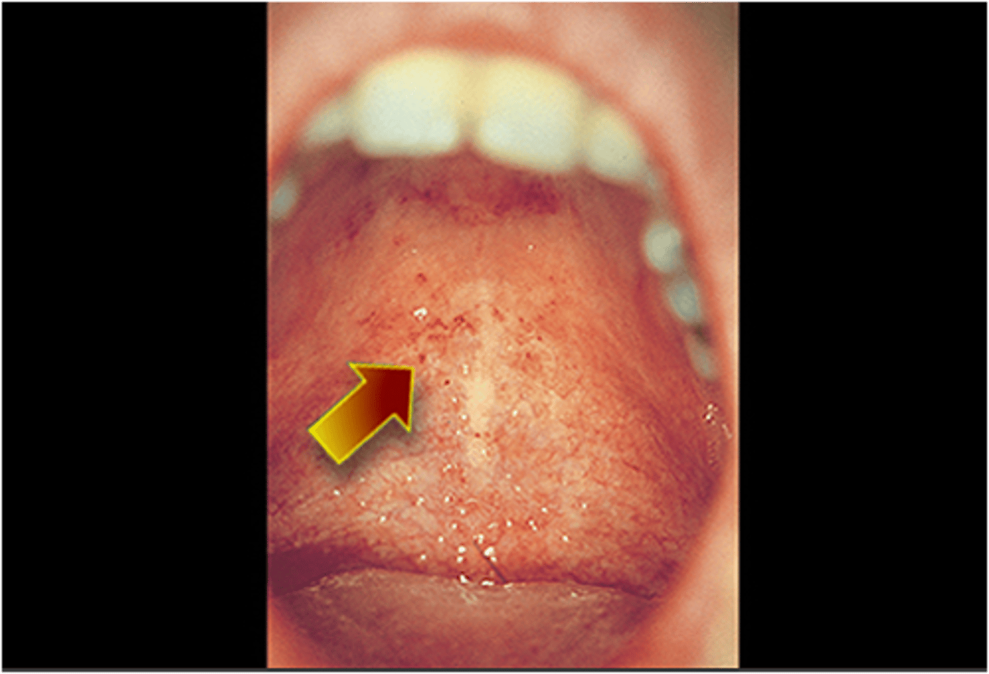 <p>-associated with forchheimer spots (rose spots) on the soft palate</p>