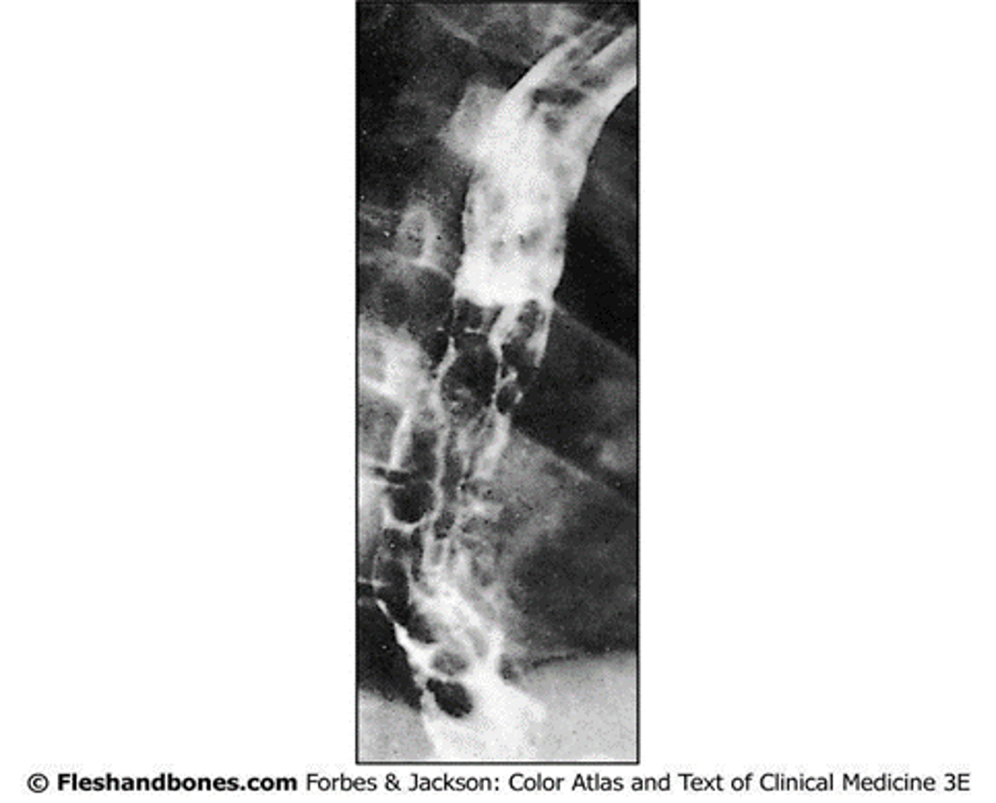 <p>What condition leads to <strong>esophageal varices</strong>?</p><p>- The lower esophagus is drained by these - dilation of esophageal veins &gt; rupture</p><p>- On barium swallow - <strong>worm-like shadows</strong></p>