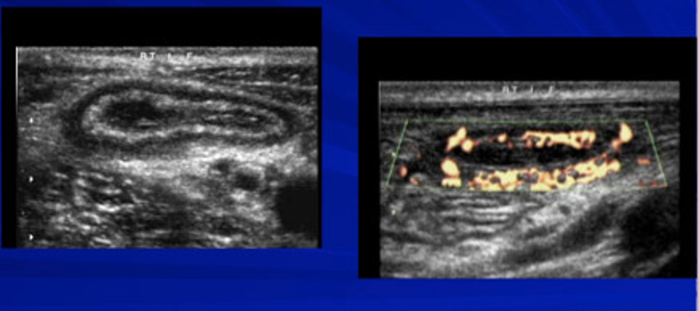 <p>Ultrasound (in adults it's CT but we want to avoid radiation exposure here) followed by MRI (best test)</p>