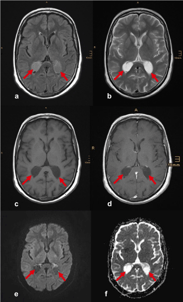 <p><span><mark data-color="unset" style="background-color: unset; color: inherit">network of capillaries and specialized cells located within the ventricles of the brain</mark>. Its primary function is to produce cerebrospinal fluid (CSF)</span></p>