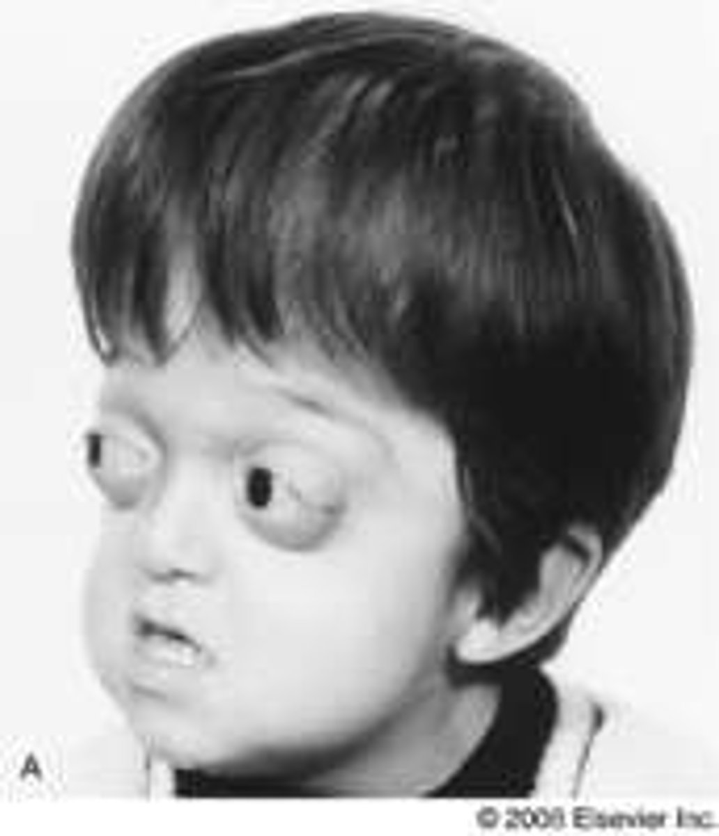<p>•Wide set proptotic eyes, beaked nose, underdeveloped jaw</p><p>•Dental issues, possible cleft lip and palate</p><p>•No associated hand/feet anomalies3</p>