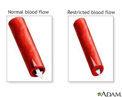 <ul><li><p>Vasoconstriction is the process where <strong>blood vessels narrow</strong> due to the <strong>contraction of smooth muscle</strong> in the vessel walls.</p></li><li><p><strong>Increases blood pressure</strong> in turn <strong>decreasing blood flow</strong>.</p></li></ul><p></p>