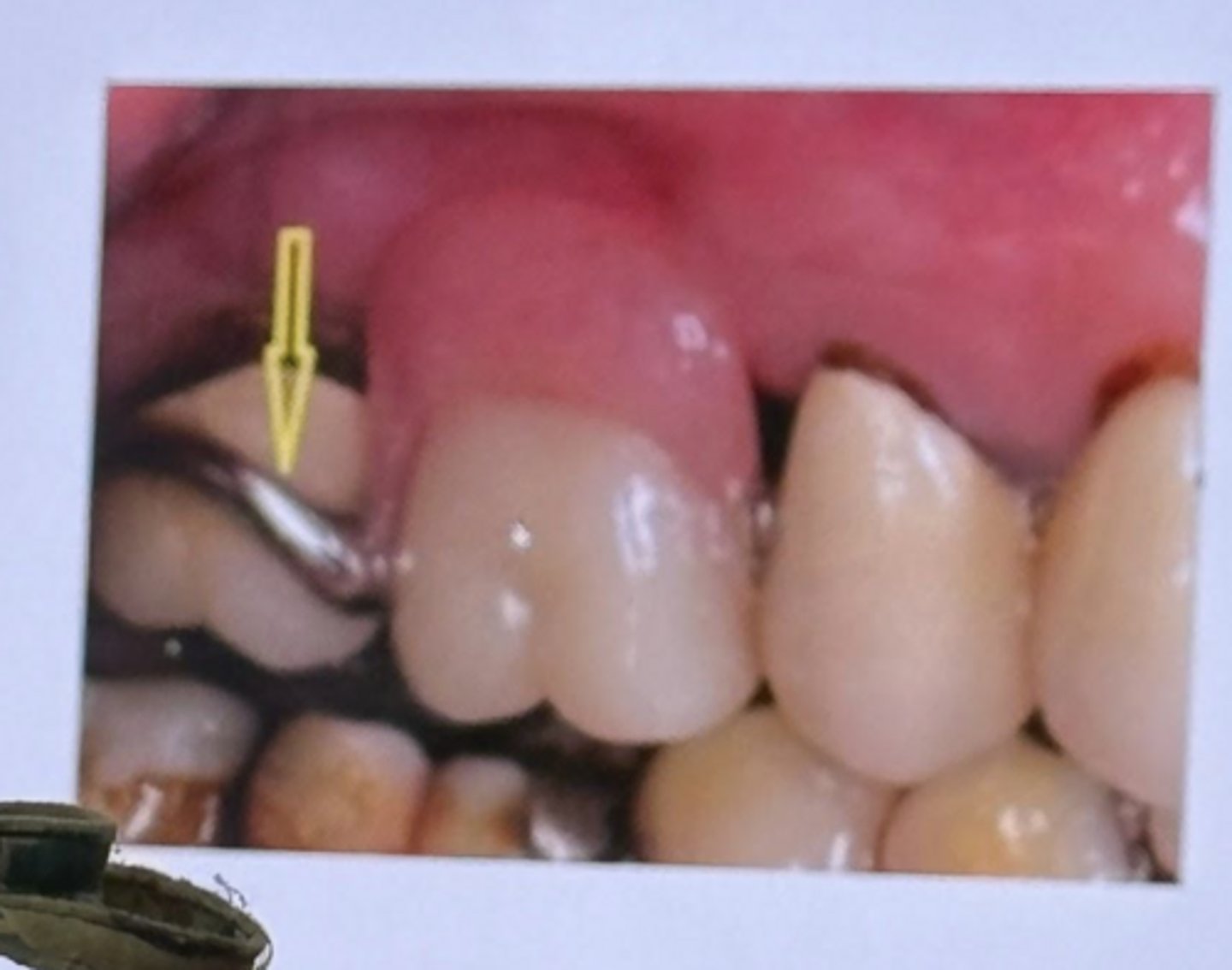 <p>-occlusal middle 1/3 of the tooth</p><p>-Above the survey line</p>