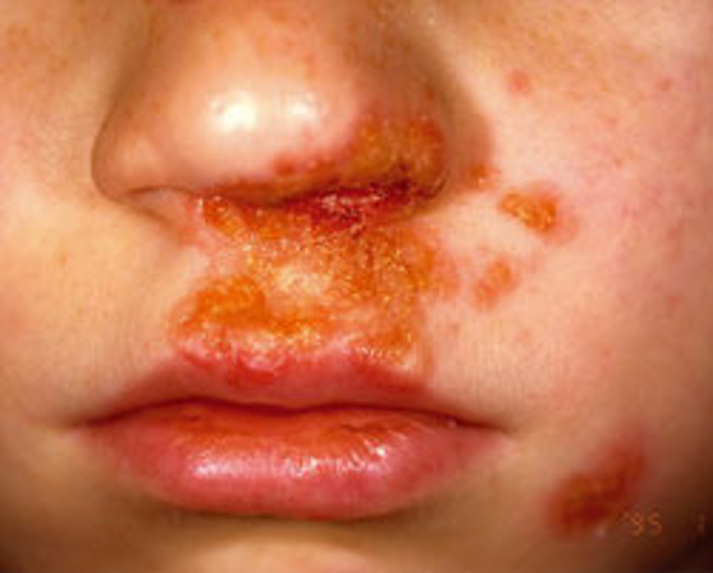 <p>- honey-colored crusted lesions</p><p>- contagious, spread through contact</p><p>- skin infections usually caused by Strep or Staph</p><p>- usually around child or infants nose, mouth, hands, and legs</p>