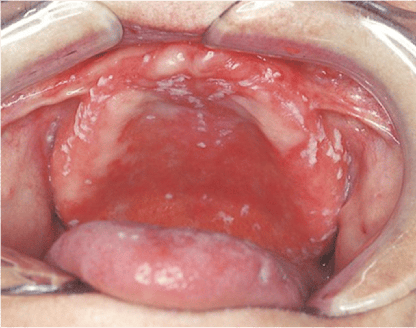 <p>Thick, white, raised patches in the mouth (this is probably caused from not cleaning the denture)</p>