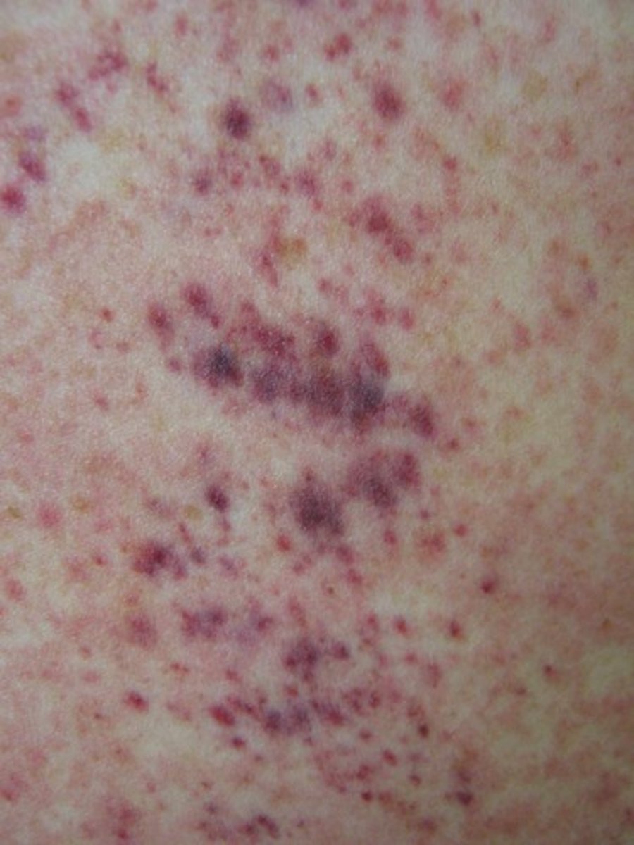 <p>Micro-hemorrhaging into tissues, usually seen at distal sites of injury</p>