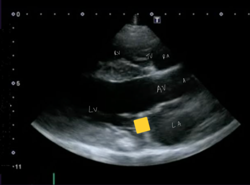 <p>Right parasternal 5 chamber view</p>