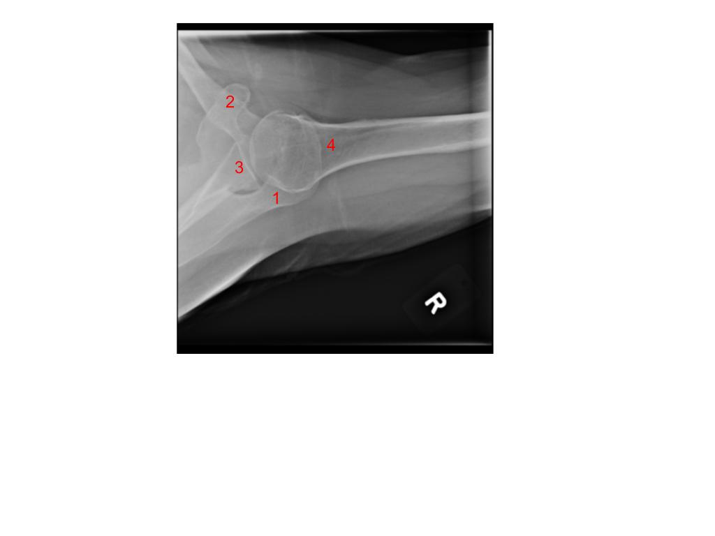 <p>What structure is #4?</p><p>A. Clavicle</p><p>B. Surgical neck of the humerus</p><p>C. Anatomic neck of the humerus</p><p>D. Coracoid process</p>