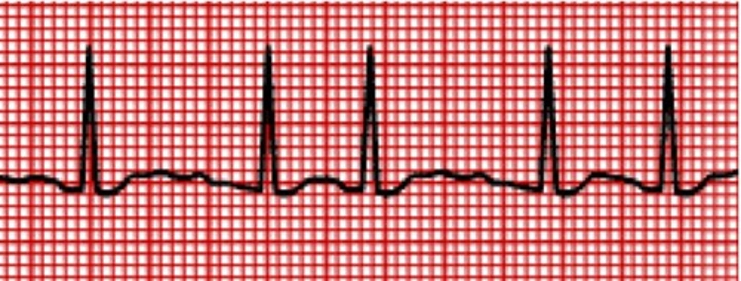 <p>rate: atrial - 300-400 bpm, ventricular: rapid, variable</p><p>rhythm: irregular</p><p>P waves: not identifiable</p><p>PR interval: not measurable</p><p>QRS duration: &lt;0.10 seconds</p>
