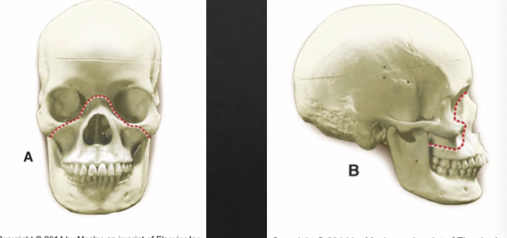 <p>pyramidal horizontal </p><ul><li><p>fracture of maxilla and nose</p></li></ul><p></p><p></p>