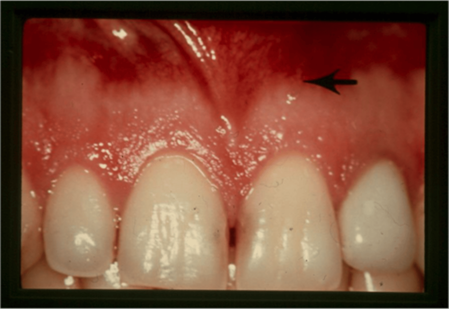 <p>clinically visible boundary where the pink attached gingiva meets the red, shiny alveolar mucosa</p>
