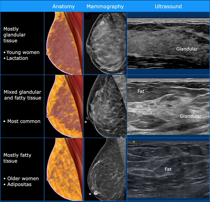 <ul><li><p>leeftijd bepaald aanvullend onderzoek</p><ul><li><p>&lt; 30 j = <span style="color: blue">echo</span></p><ul><li><p>mammogram = witter (relatief meer klierweefsel) → maskeert klierweefsel</p></li></ul></li><li><p>&gt; 30 j = <span style="color: blue">mammografie</span></p></li></ul></li><li><p>afwijkingen borstweefsel</p><ul><li><p><span style="color: green">cyste </span>= glad begrenst</p><ul><li><p><span style="color: blue">echo </span>= ziet achterwand bij interface</p></li><li><p>pijnlijk? = geruststellend</p></li><li><p>géén behandeling/follow up</p></li></ul></li><li><p><span style="color: green">carcinoom </span>= grillige afwijking (mog morfologische afwijkend lymfeklier oksel)</p><ul><li><p>gevoelloos</p></li><li><p>maligne biopt lymfeklier → meer risico afstand metastasen</p></li><li><p>aanvullend onderzoek = <span style="color: blue">18F-FDG PET-CT</span></p></li></ul></li><li><p>mastopathie = verzamelnaam goedaardige aandoening borstweefsel</p></li></ul></li></ul><p></p>