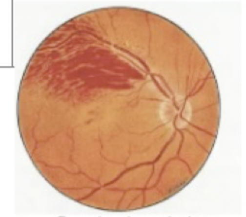 <p>Patient reports to the clinic stating she is seeing a dark spot in her left eye and that everything looks burry and grey. She reports no pain, just the blurred vision in the left eye. You see this during the physical exam. What do we need to do next?</p>