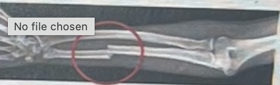 <p>This image is an example of what type of fracture</p>