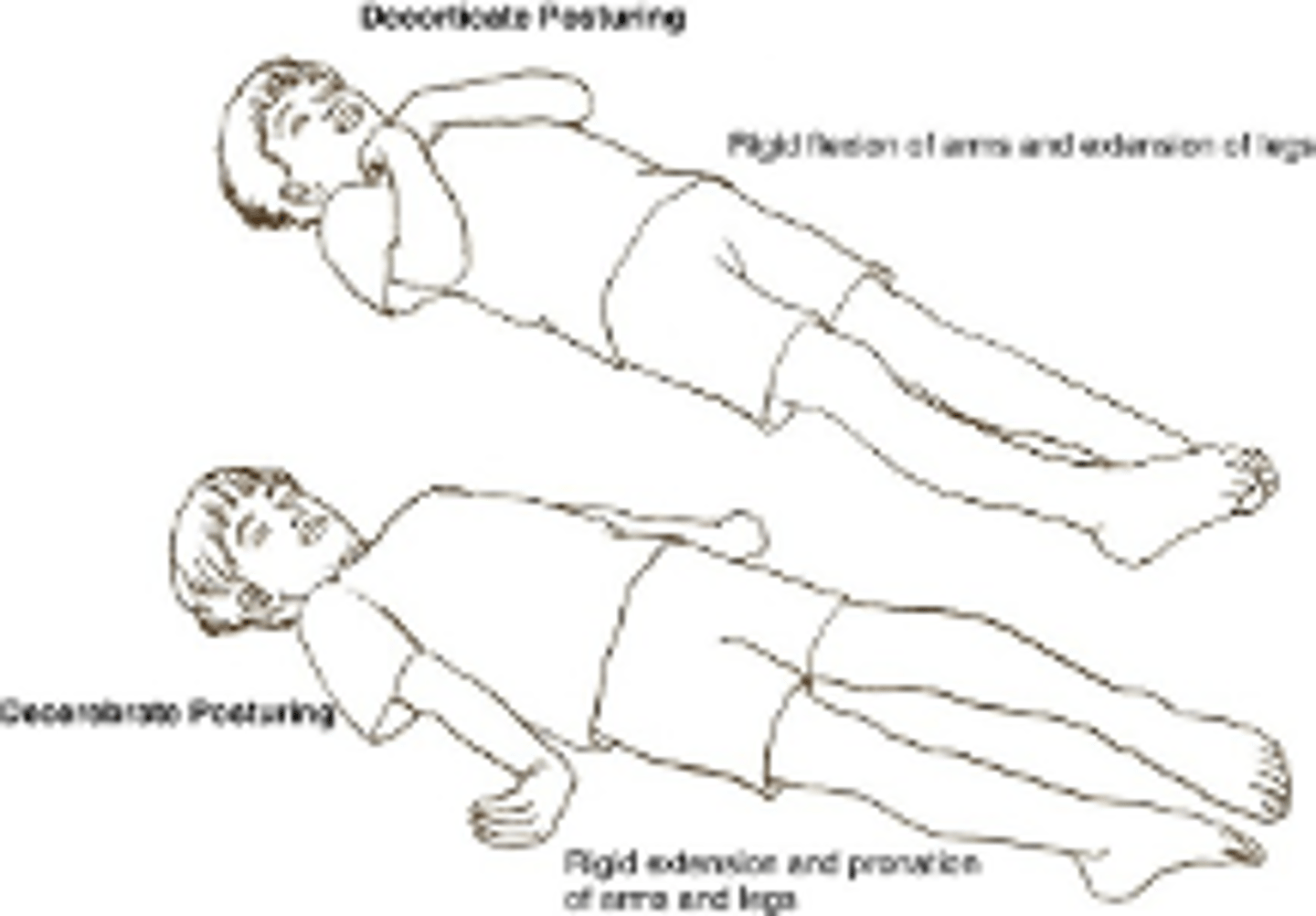 <p>extensor posturing arms extended, adducted and internally rotated, wrists pronated, legs extended and plantar flexed, neck extended</p>