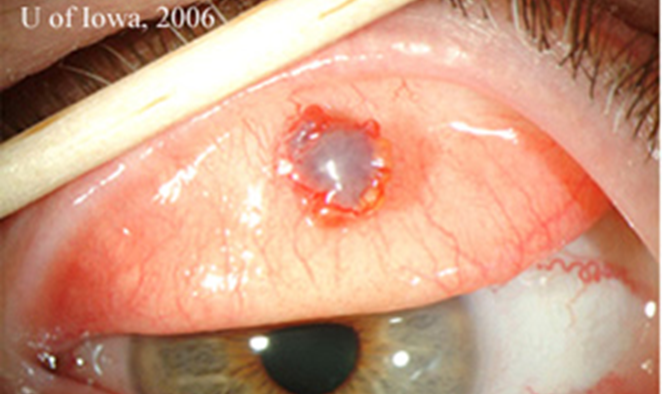 sebaceous gland carcinoma