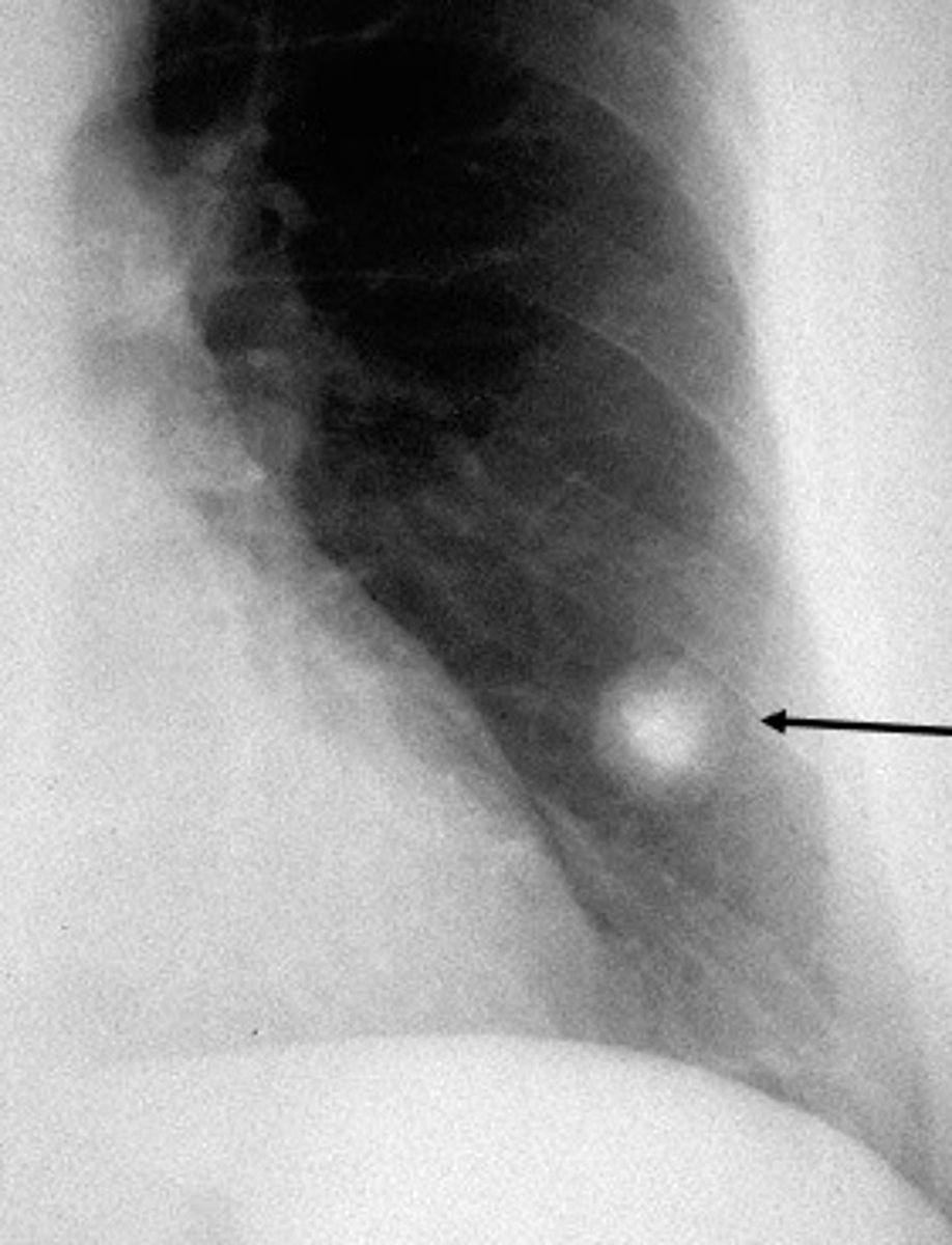 <p>hamartoma</p>