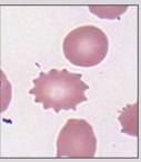 <p>Spiculated red cells with short, <strong>equally-spaced projections</strong> over the entire surface</p>