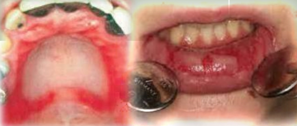 <p>Focal or widespread erythema, with vesicles and ulcers.</p><p class="has-focus">Burning sensation and pain</p><p class="has-focus">First and second decade</p><p class="has-focus">No gender bias</p><p class="has-focus"><strong>Found on:</strong></p><p class="has-focus">Any mucosal site</p><p class="has-focus"></p><p class="has-focus is-empty">Ask: Use of new oral hygiene products/topical medications/cosmetic products? New/ rarely eaten food?</p><p class="has-focus">See if any dental materials near site</p>