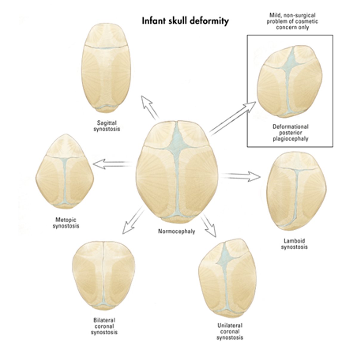 <p>the premature ossification of 1 or more sutures resulting in bulging at the fontanelle at the contralateral side. Treated by helmets and or surgery</p>