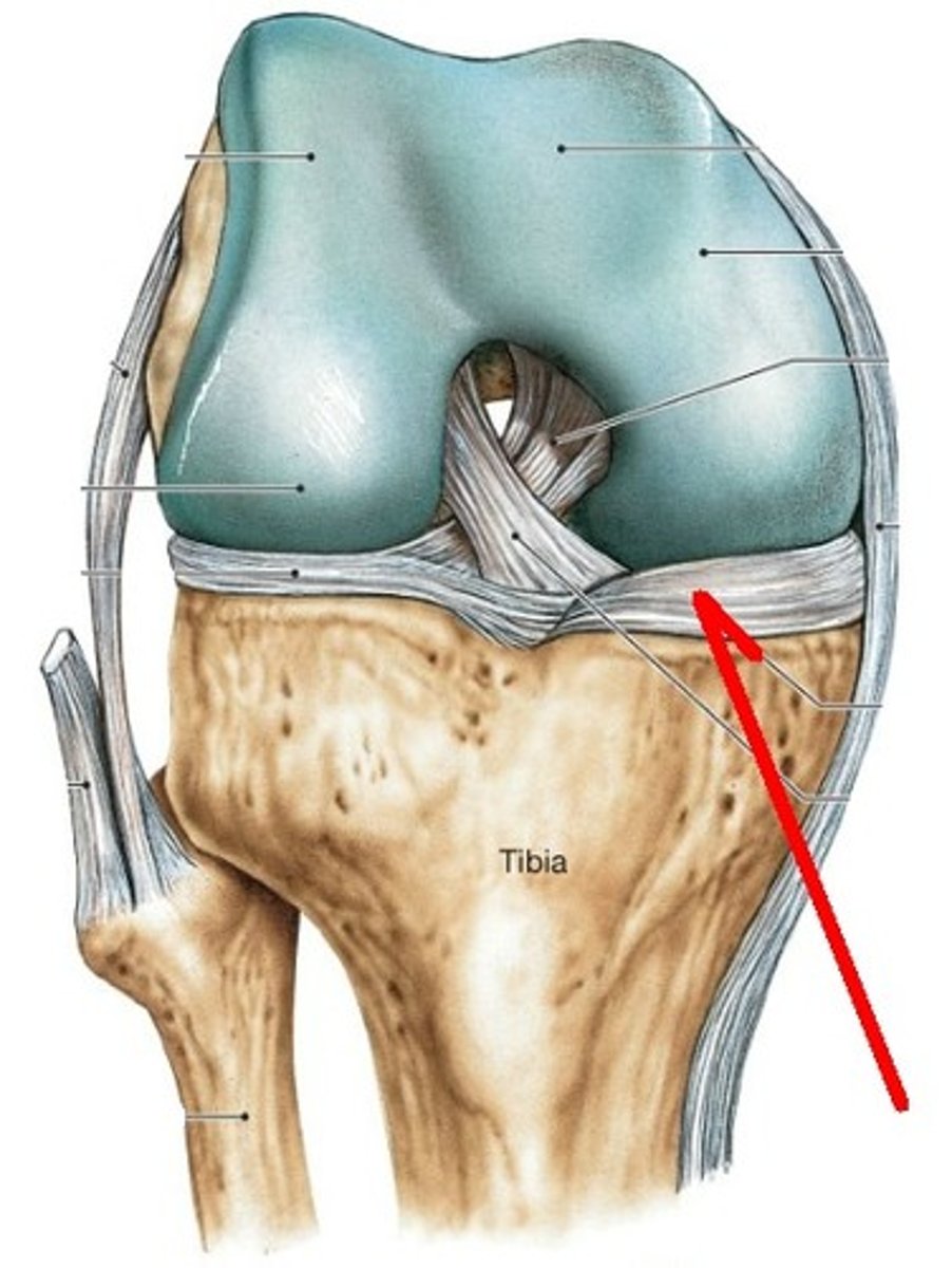 <p>the medial semilunar-shaped fibrocartilage disc attached to the tibial condyle</p>