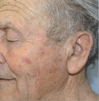 <p>scaly plaques on face, lip, ears, scalp, neck, arms, etc </p>
