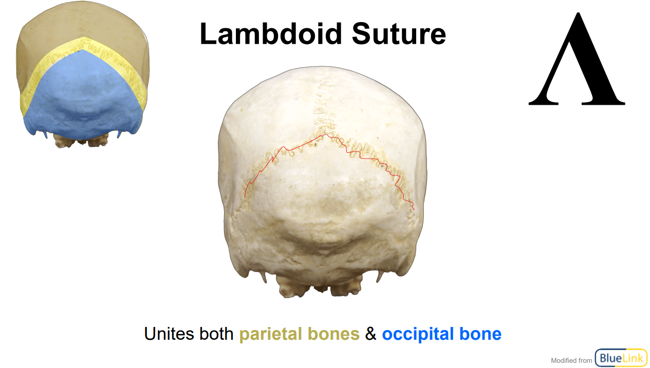 <p>United both <span style="color: yellow">parietal bones</span> &amp;<span style="color: blue"> occipital bone</span></p>