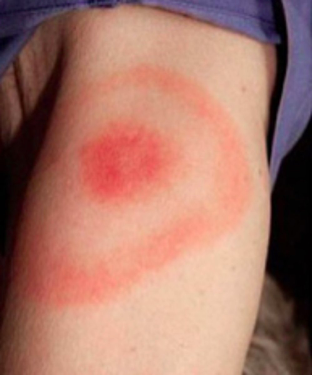 <p>Stage 1: Early localized </p><p>(Erythema migrans 80%)</p>