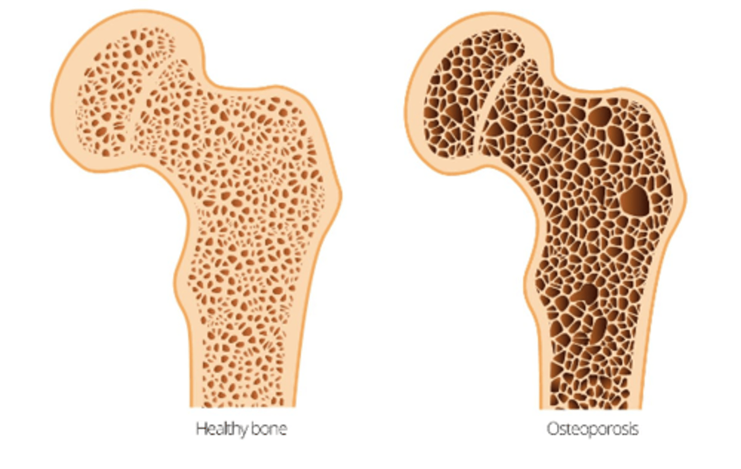 <p>Osteoporosis </p>