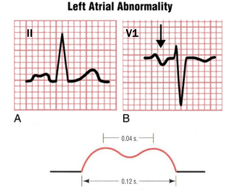 <p>upright humped P wave at least 0.12 s in duration and 0.4 s distance bt humps</p><p>biphasic P wave w/ small initial pos deflection and large neg terminal deflection in V1</p>
