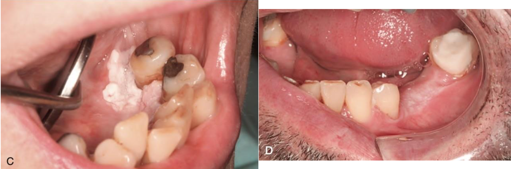 <p>which neoplastic white lesion:</p>