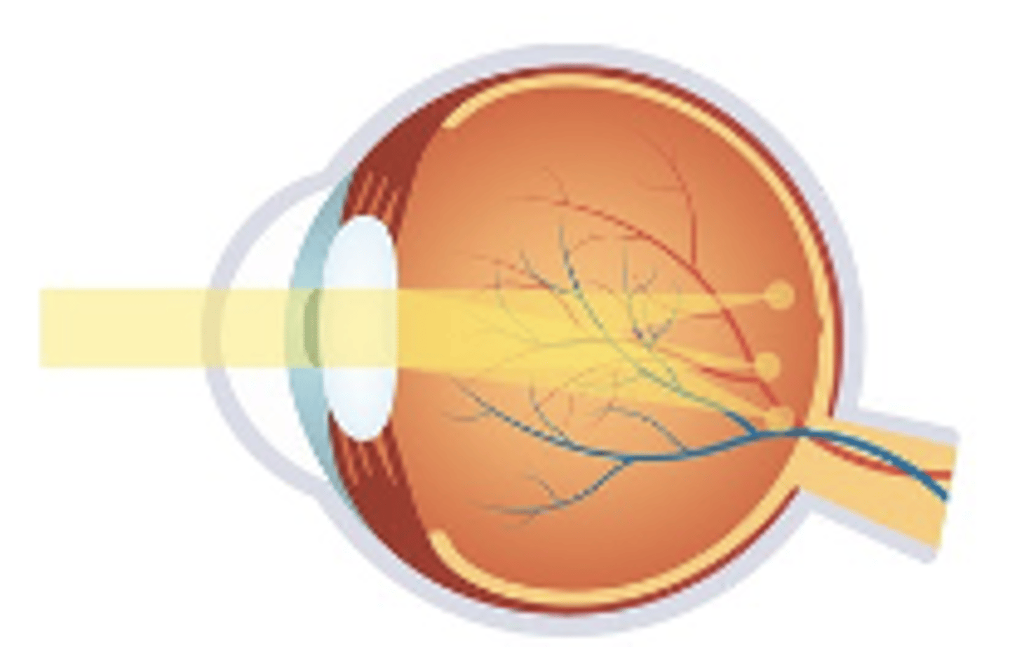 <p>-Eye shaped like a football not soccer ball</p><p>-Lower amounts are asymptomatic, vision worse at distance &amp; near with higher amounts</p>