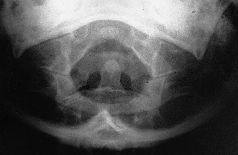 <p>What is this x-ray demonstrating?</p>