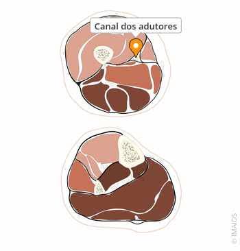 <p>Limite Anterolateral do canal dos adutores </p>