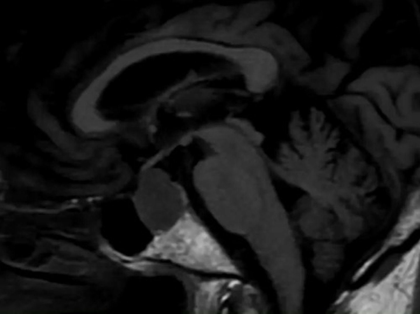 <p>Almost always benign adenoma—micro in size and non-functional</p><p>Many are incidentally found after death, up to 25%</p>