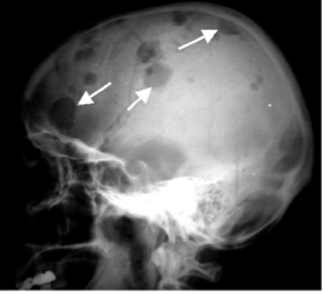 <p>malignancy of bone in adults</p><p>solitary plasmacytoma- often seen as a soap-bubbly, expansile lesion in spine or pelvis</p><p>punched out lytic lesions- throughout axial and proximal appendicular skeleton</p>