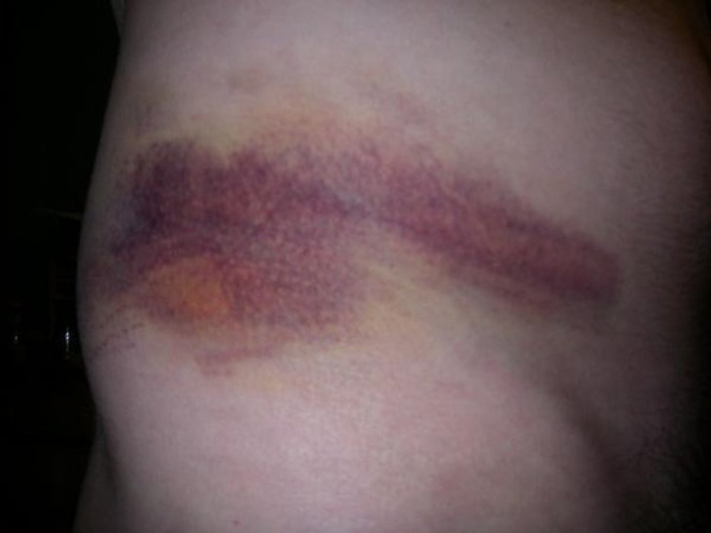 <p>bleeding within the body that results from closed wounds such as bruises</p>