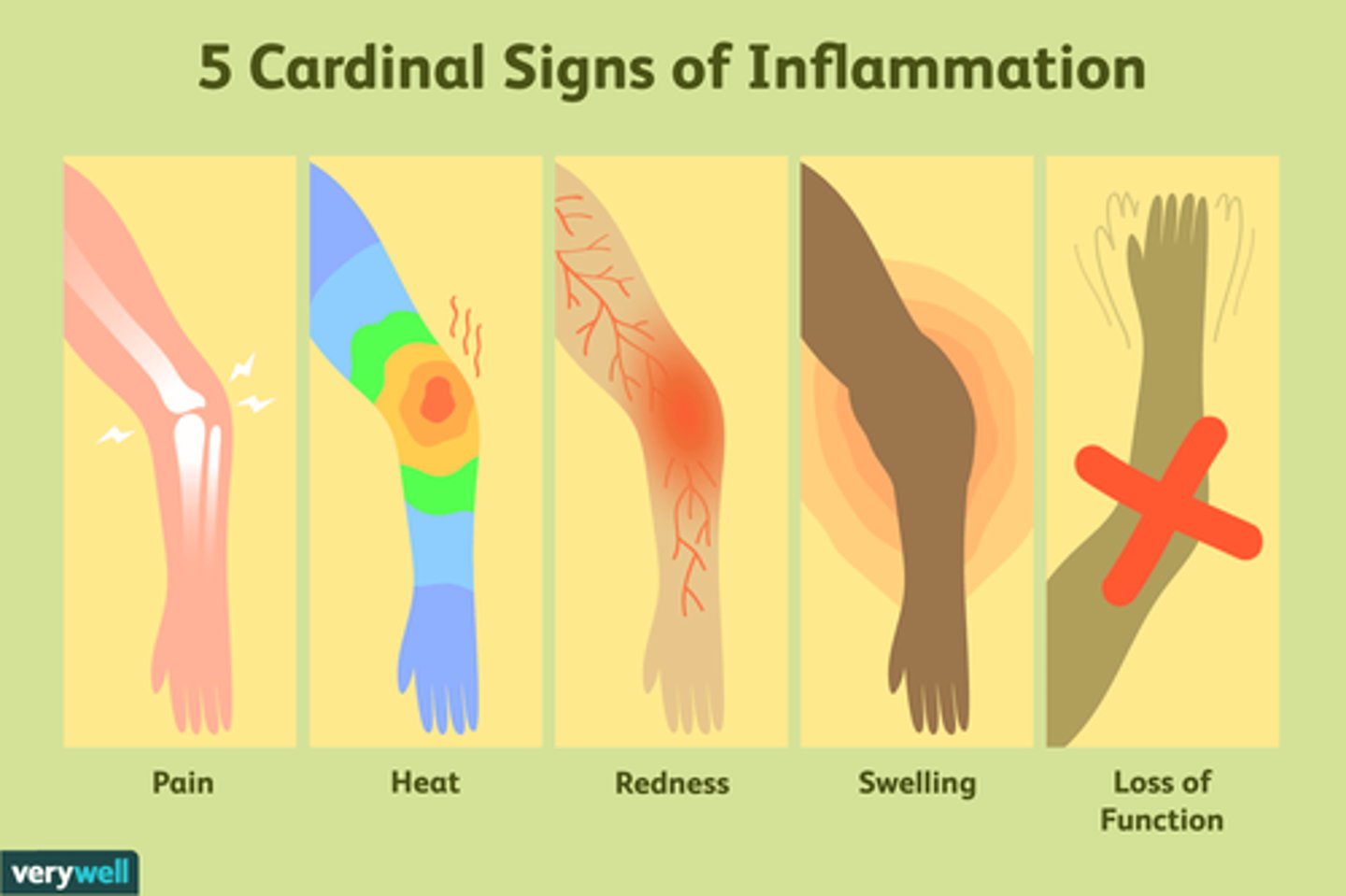 <p>1. Redness (rubor)</p><p>2. Heat (calor)</p><p>3. Swelling (Tumor)</p><p>4. Pain (Dolor)</p>
